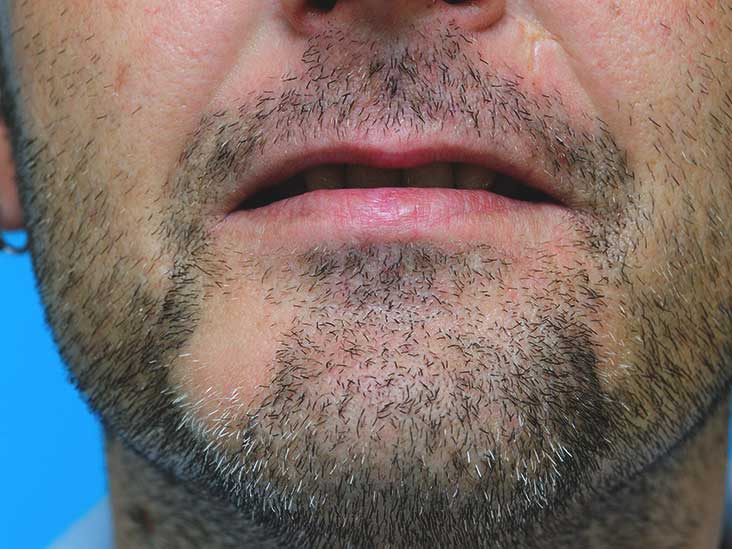 Corticosteroids