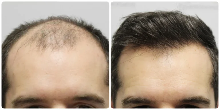Before and after, example 2